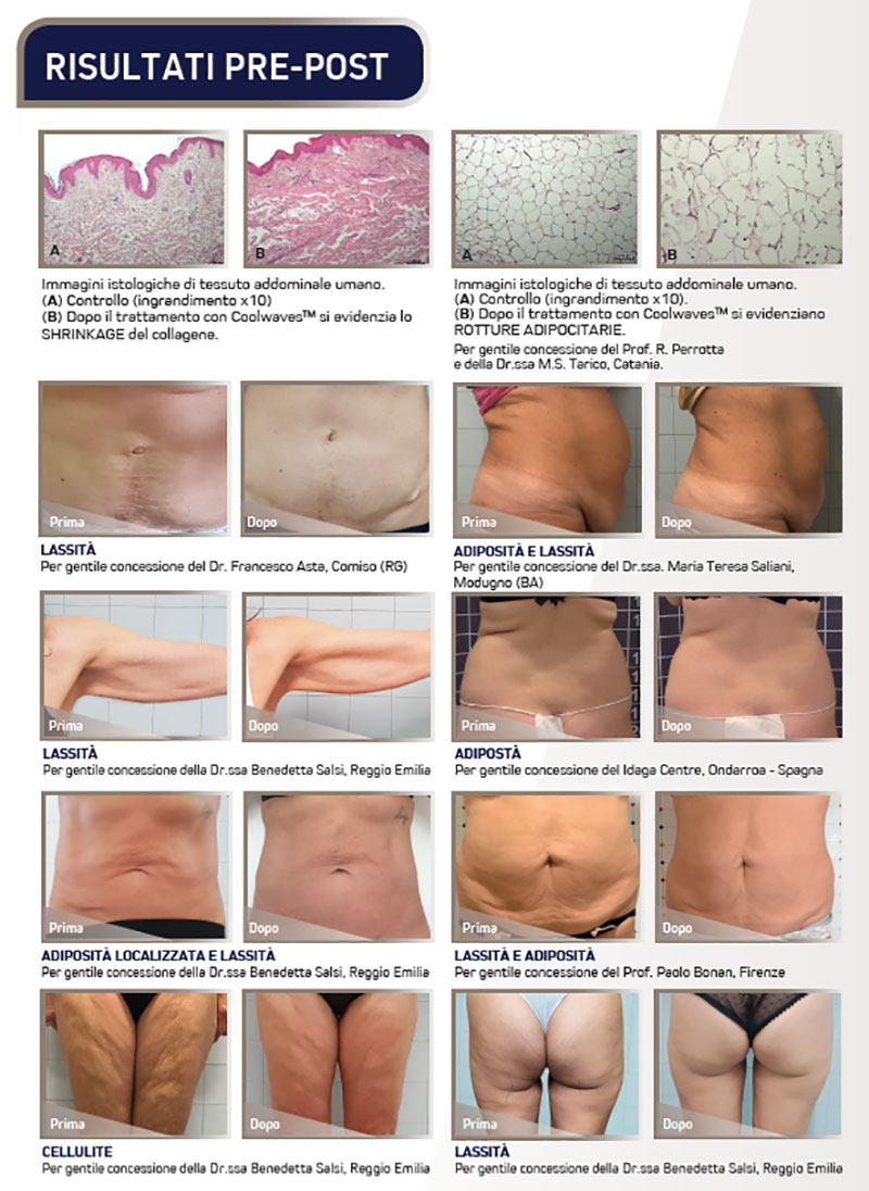 Onda trattamento per ridurre la cellulite Onda trattamento per ridurre la cellulite