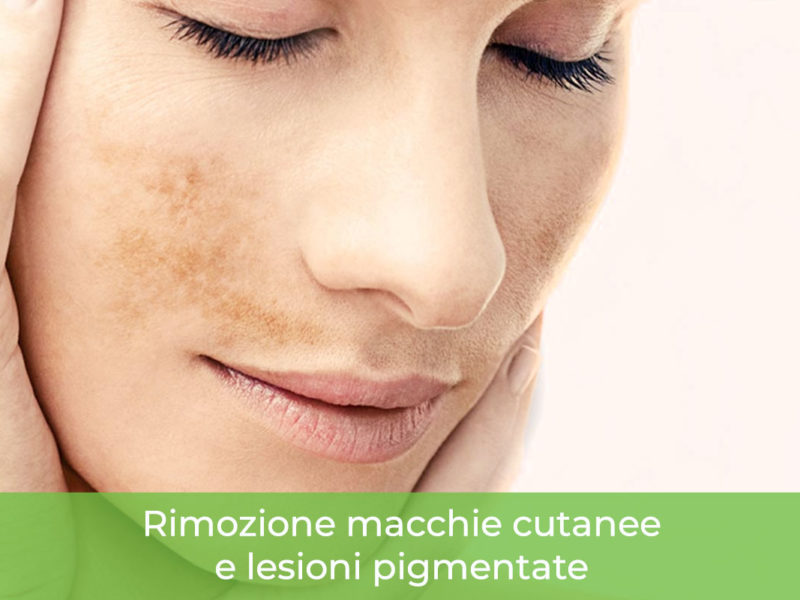 Rimozione macchie cutanee Monza Brianza