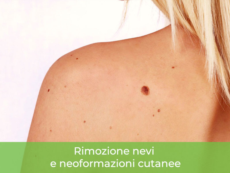 Rimozione nei Monza Brianza