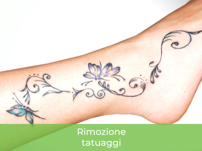 Rimozione tatuaggi Monza Brianza