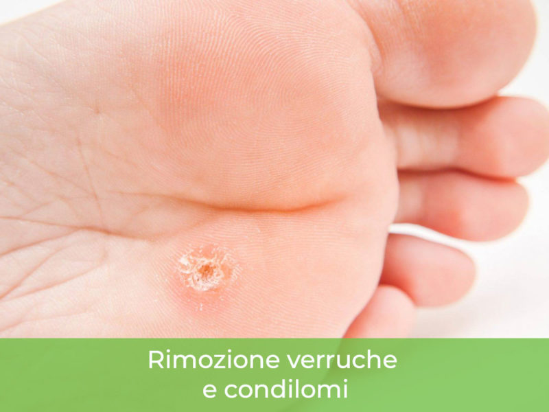Rimozione verruche Monza Brianza