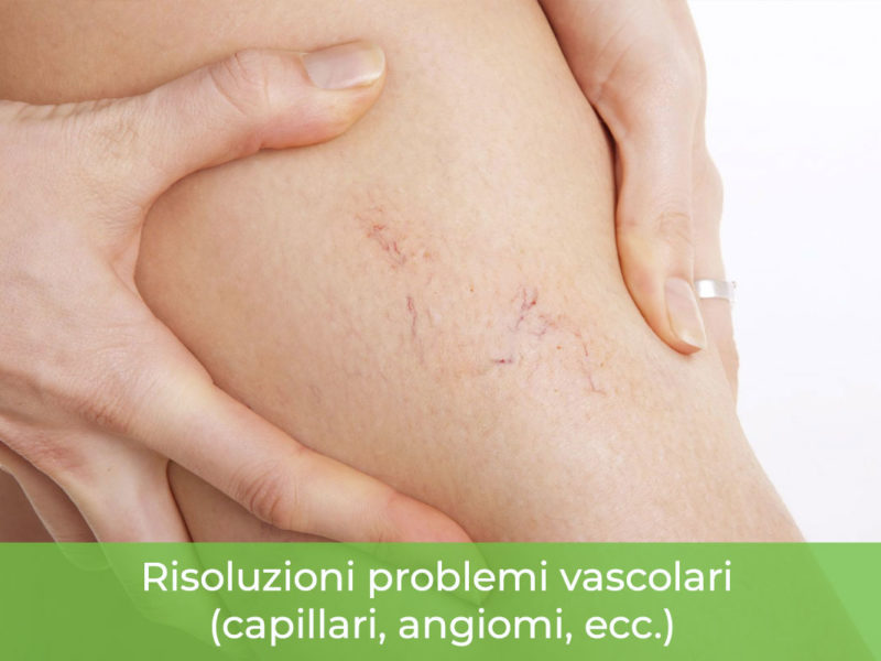 Risoluzione problemi vascolari vene varicose Monza Brianza