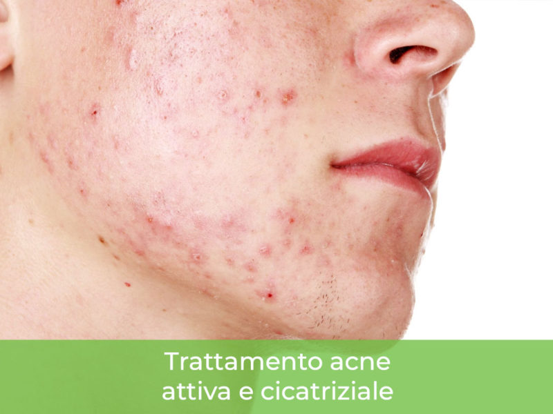 Trattamento acne Monza Brianza