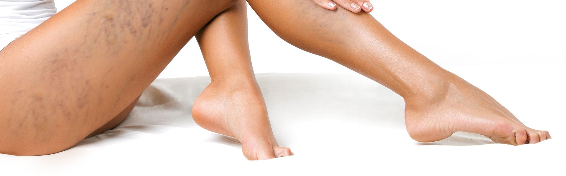 Rimozione capillari gambe Monza Brianza Rimozione capillari gambe Monza Brianza