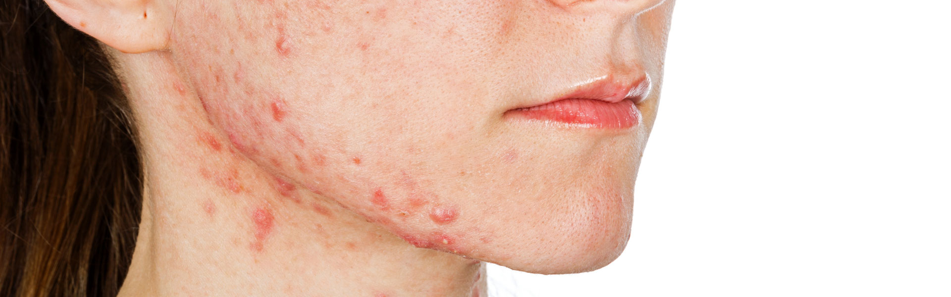 Soluzione acne e cicatrici Monza Brianza Soluzione acne e cicatrici Monza Brianza