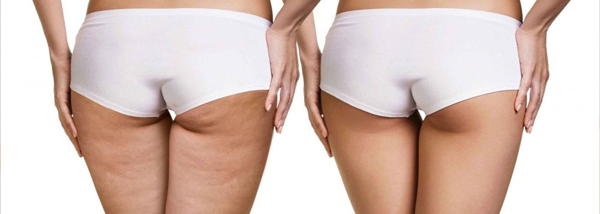 Mesoterapia cellulite Monza Brianza Mesoterapia cellulite Monza Brianza