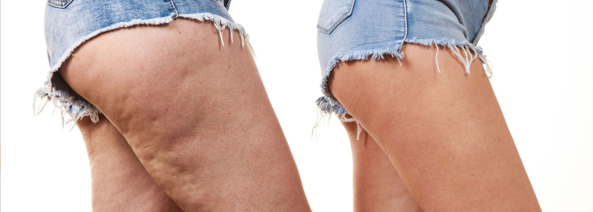 Mesoterapia cellulite Monza Brianza Mesoterapia cellulite Monza Brianza