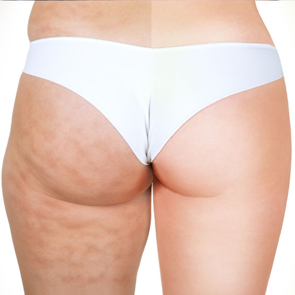 Mesoterapia cellulite Monza Brianza Mesoterapia cellulite Monza Brianza