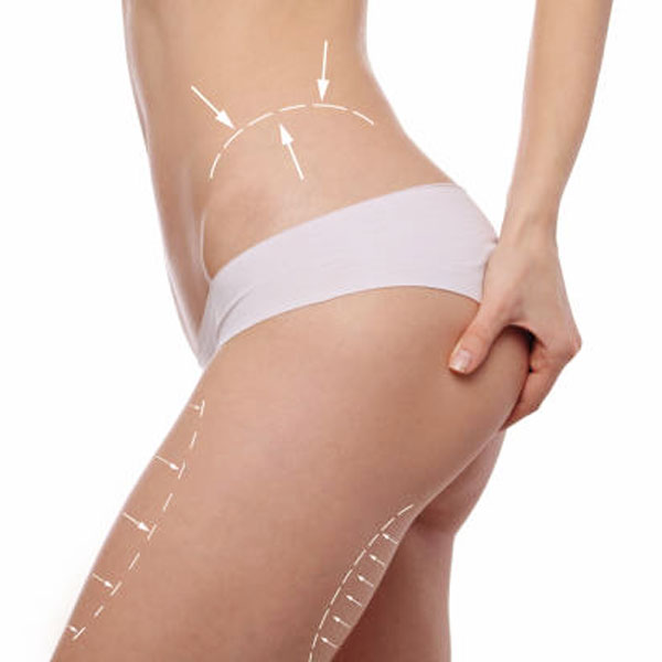 Ozonoterapia cellulite Monza Brianza