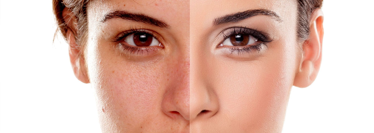 Peeling chimico Monza Brianza