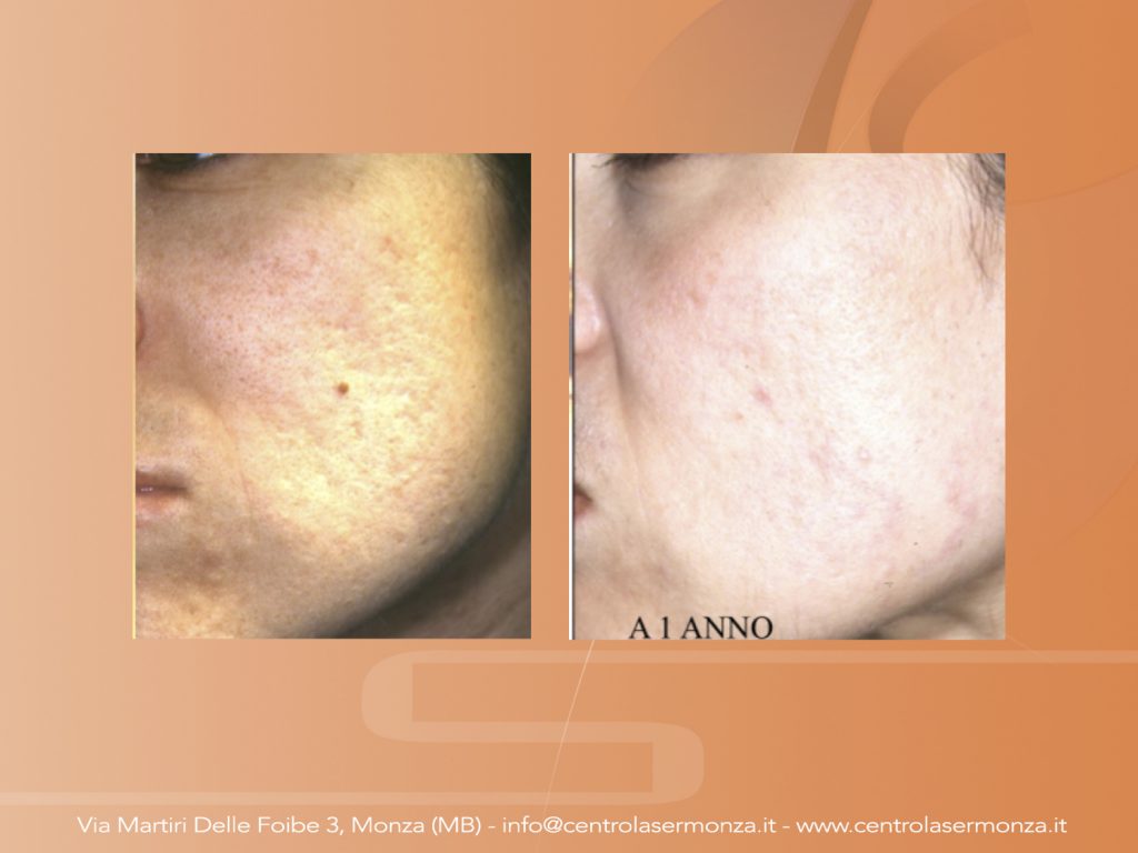 Rimuovere acne e cicatrici Monza Brianza