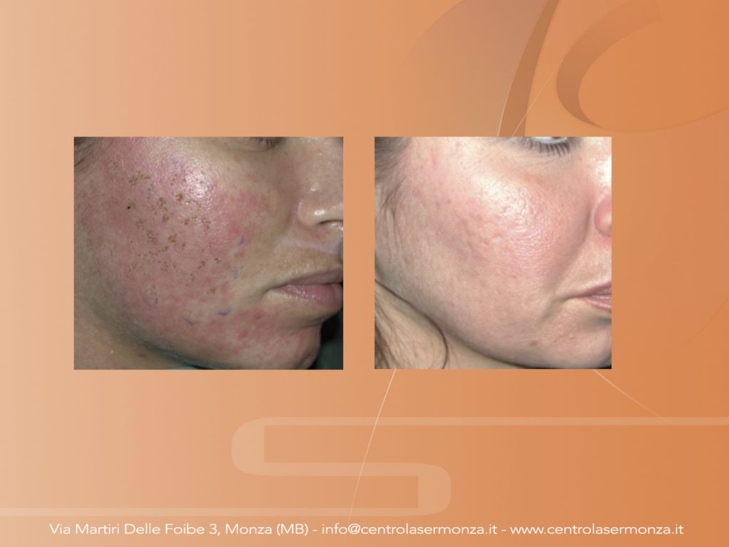 Rimuovere acne e cicatrici Monza Brianza