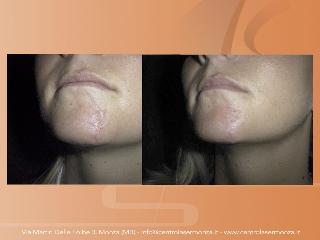 Rimuovere acne e cicatrici Monza Brianza