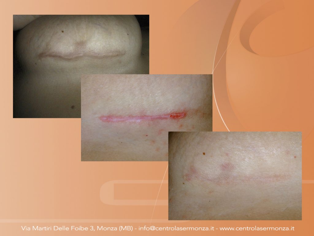 Rimuovere acne e cicatrici Monza Brianza