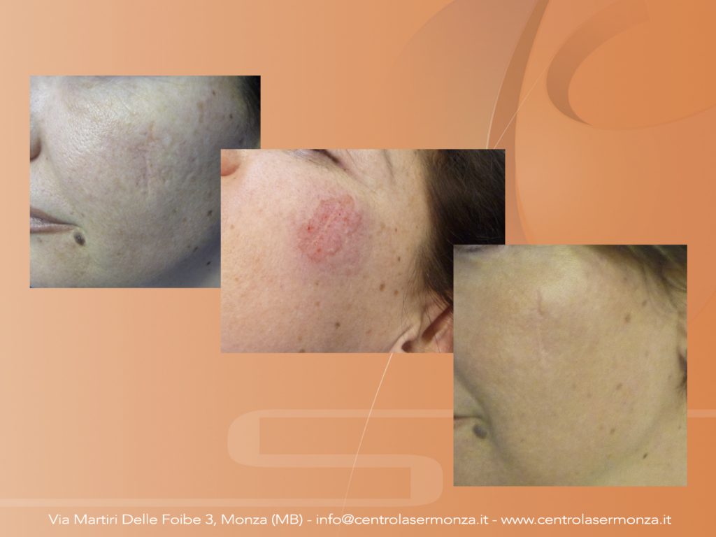 Rimuovere acne e cicatrici Monza Brianza