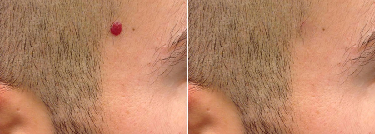 Rimuovere Angioma Monza Brianza Rimuovere Angioma Monza Brianza