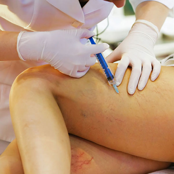 Scleroterapia Monza Brianza Scleroterapia Monza Brianza