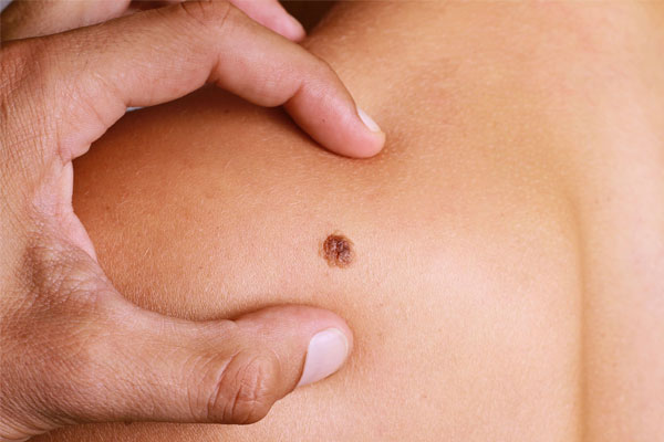 Visita prevenzione melanoma Monza Brianza-03