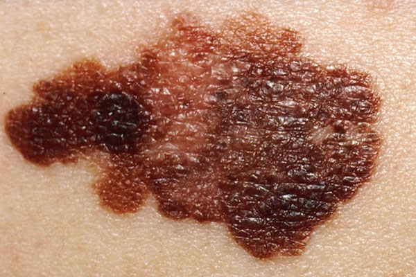 Visita prevenzione melanoma Monza Brianza-03