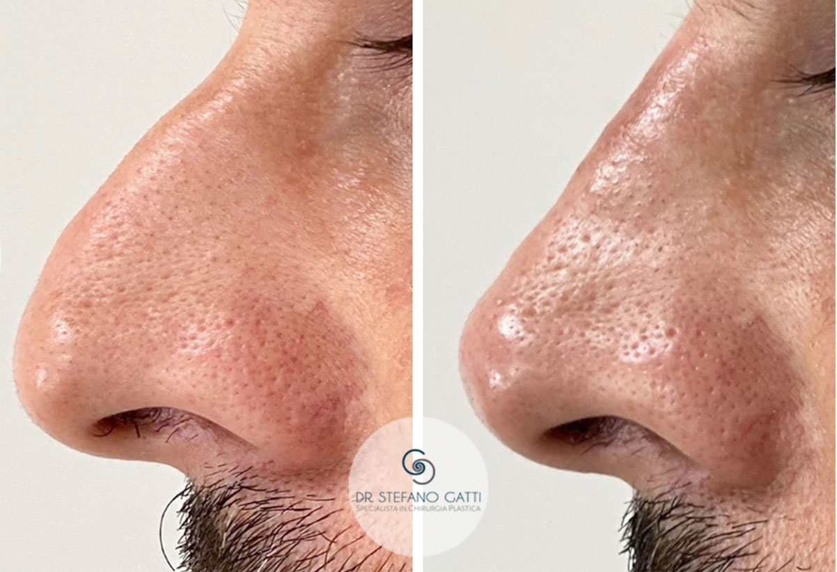 Rinofiller by Dr.Stefano Gatti Rinofiller by Dr.Stefano Gatti