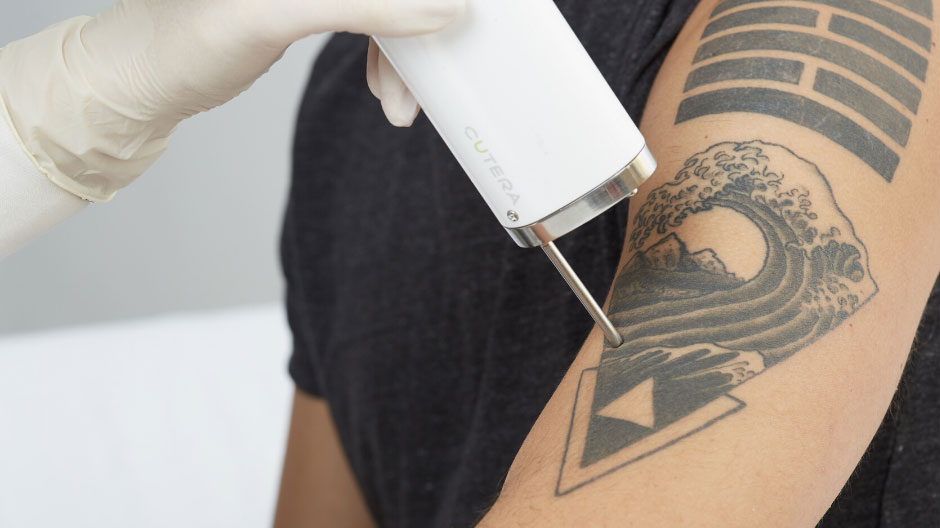 Rimozione tatuaggi Monza e Brianza Rimozione tatuaggi Monza e Brianza