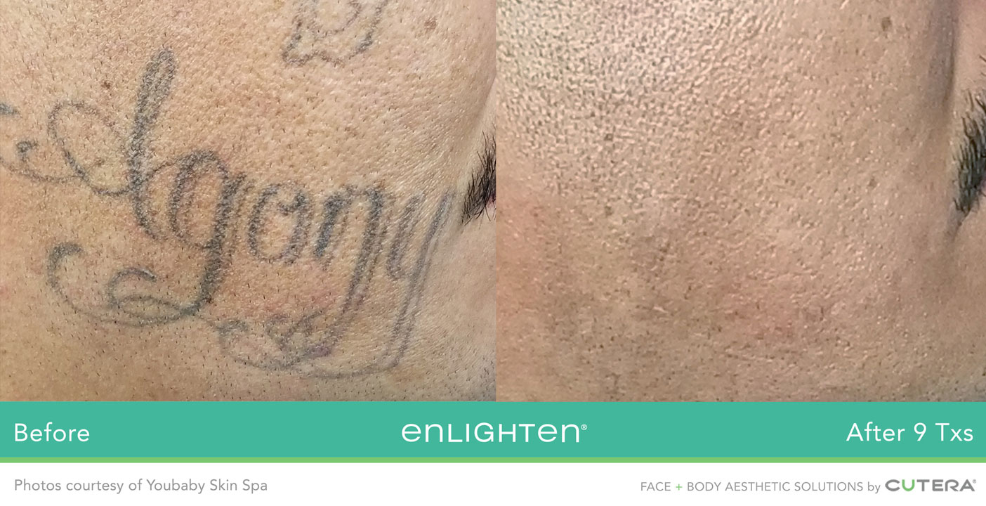 Rimozione tatuaggi Monza e Brianza Rimozione tatuaggi Monza e Brianza