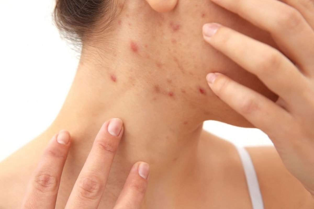 trattamenti-per-la-psoriasi Trattamenti per la psoriasi